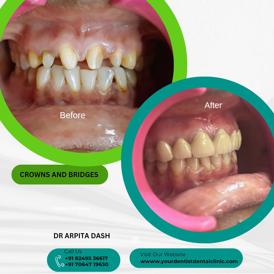 Crowns and Bridges treatment result at YourDentist Laser Dental Clinic Bhubaneswar