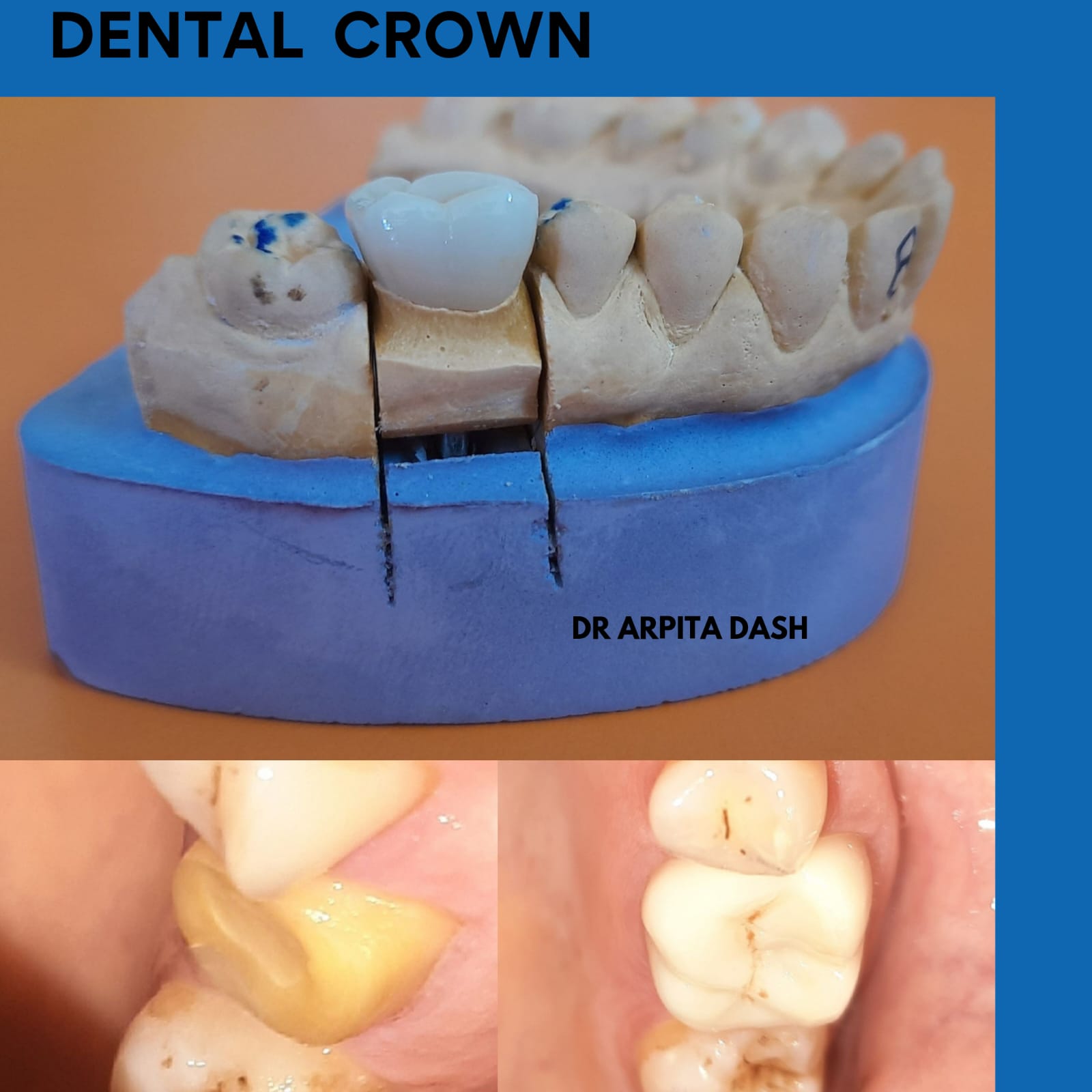 Dental Crown treatment result at YourDentist Laser Dental Clinic Bhubaneswar