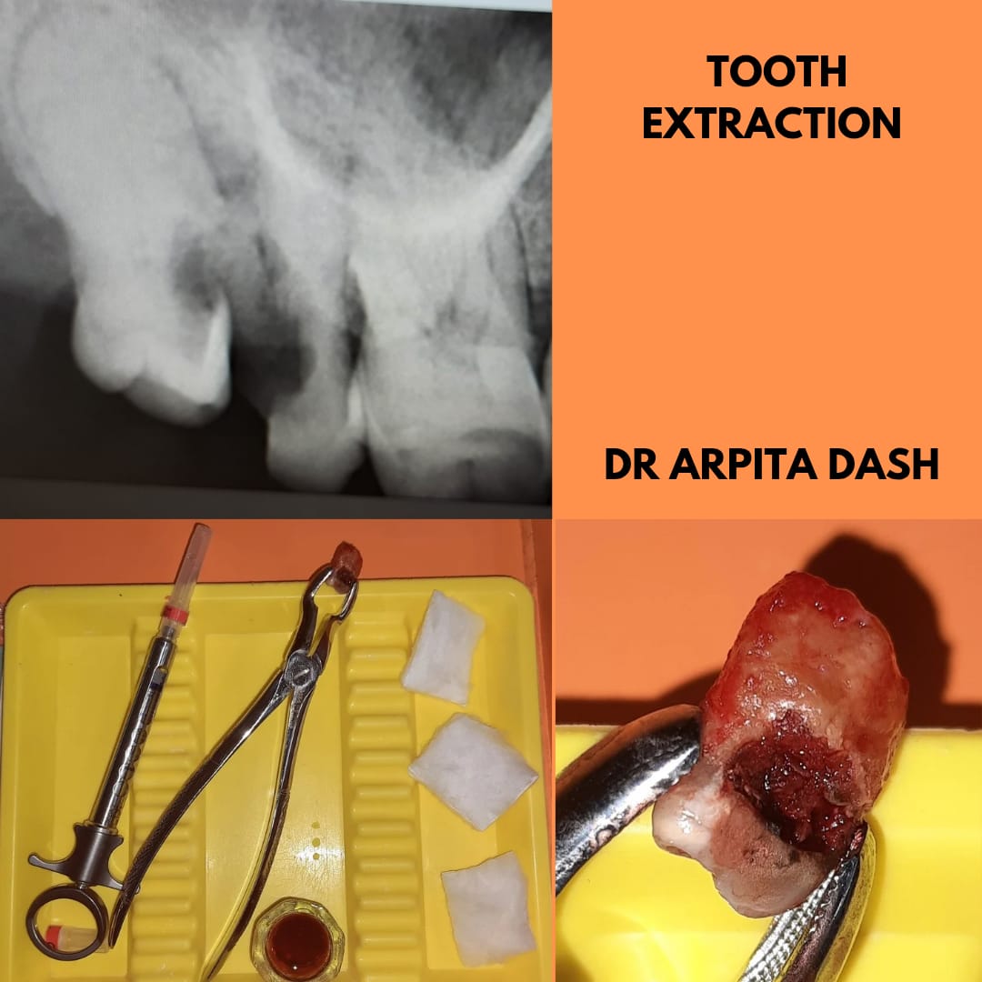 Tooth Extraction result at YourDentist Laser Dental Clinic Bhubaneswar