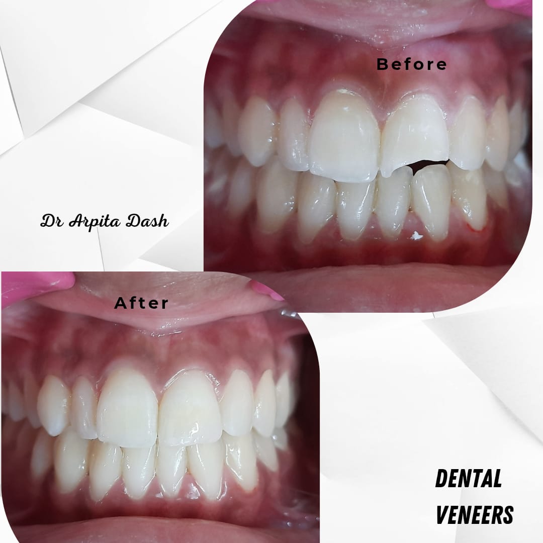 Dental Veneers treatment result at YourDentist Laser Dental Clinic Bhubaneswar