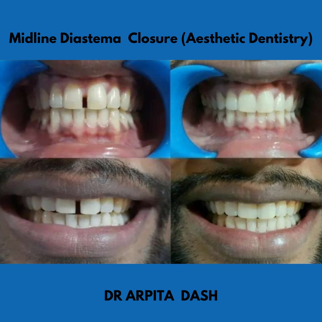 Aesthetic Dentistry result at YourDentist Laser Dental Clinic Bhubaneswar